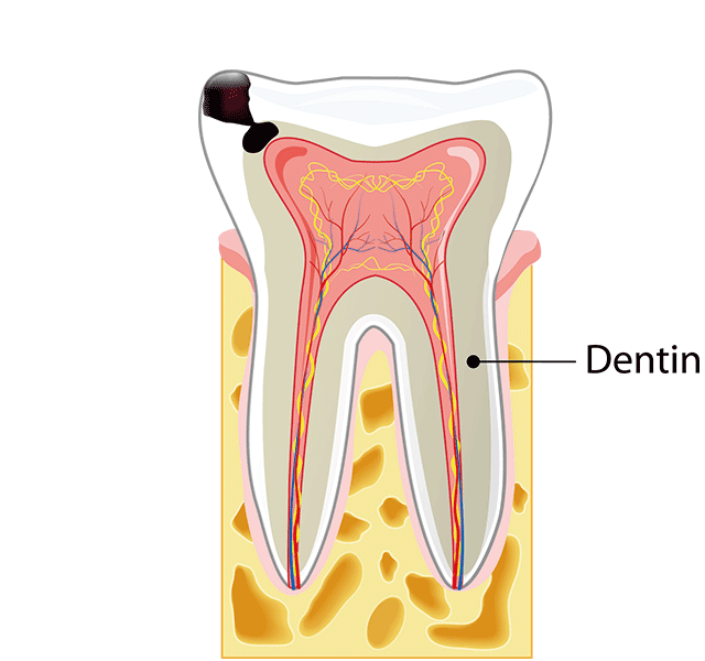 C2：むし歯が歯の内部まで進行